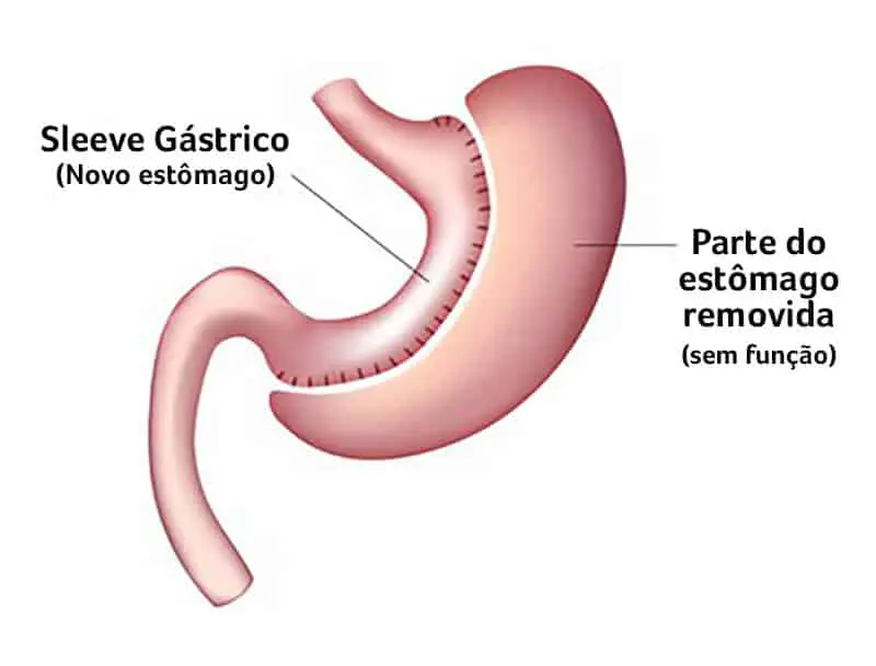 Sleeve Gástrico: O que é e para quem é indicado