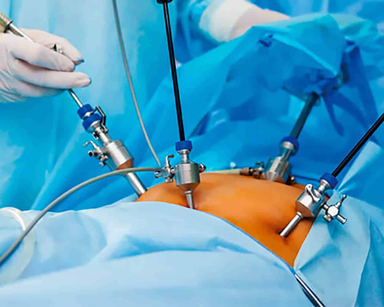 Cirurgia Por Videolaparoscopia Rr Médicos Cirurgiões 7316