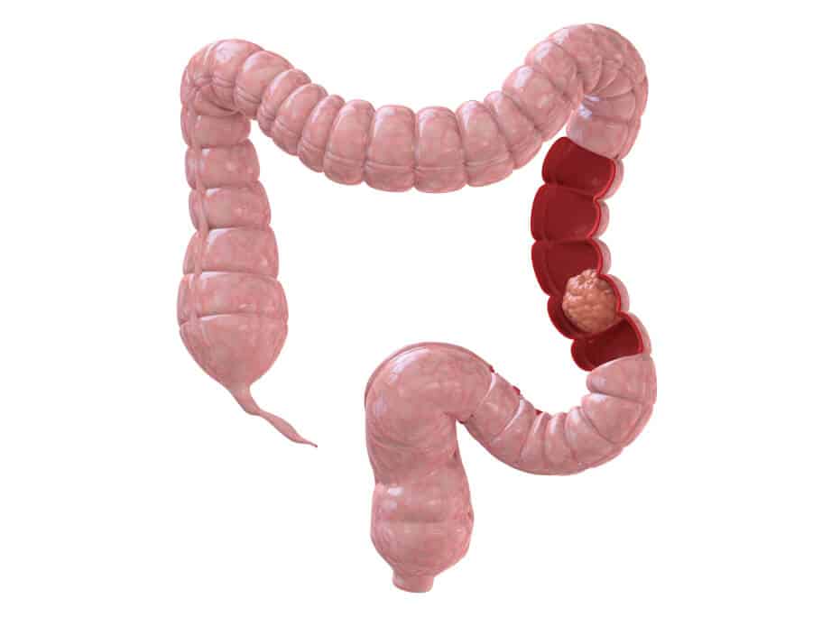 pólipo intestinal