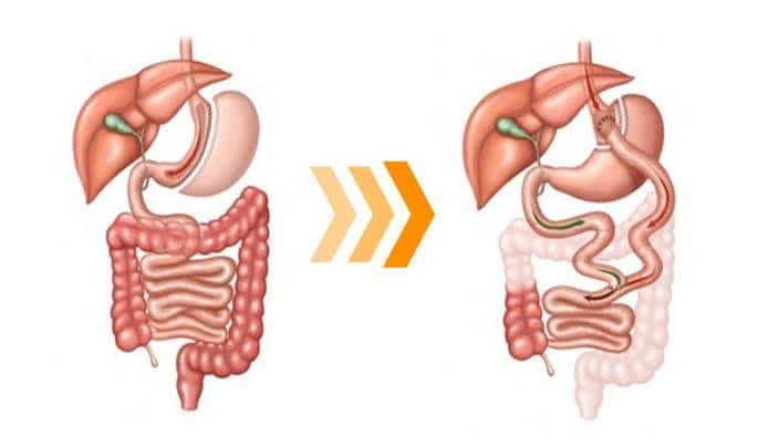 transformação do Sleeve para Bypass