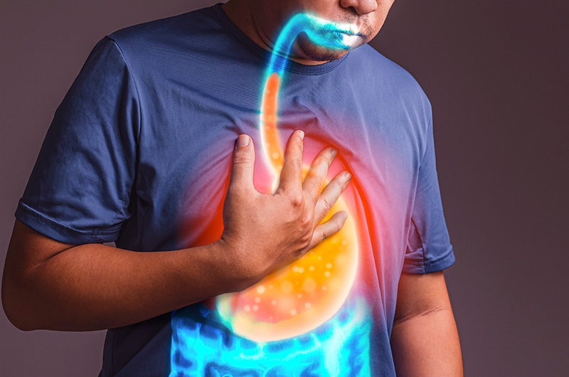 Transformando Sleeve em Bypass Gastrico para melhora do Refluxo