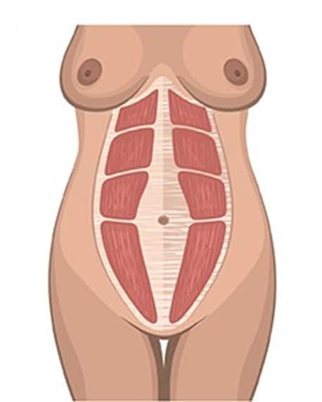 Diástase de Parede Abdominal